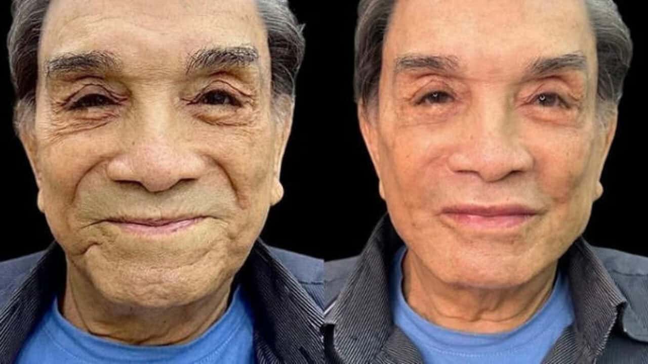 Guilherme Leicam faz harmonização facial e botox no rosto todo